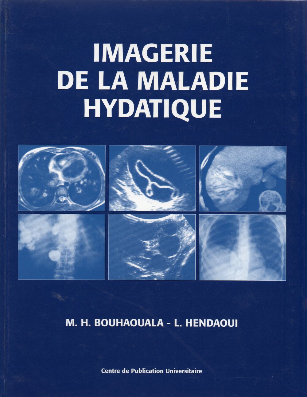 Imagerie de la maladie hydatique